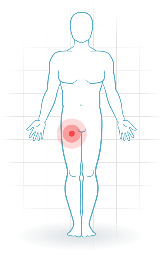 pijnlocatie Rectus femoris tendinopathy