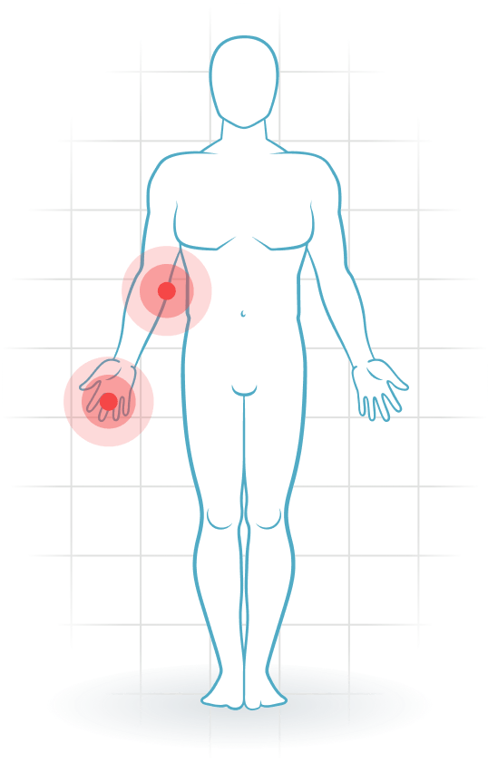 pijnlocatie Cubital tunnel syndrome