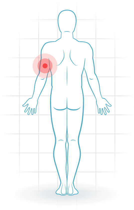 pijnlocatie Triceps injury